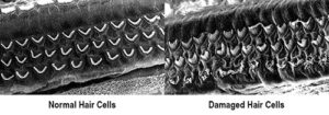 diagram showing normal hair cells vs damaged hair cells in our ears